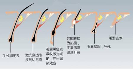 脫毛儀原理(lǐ)