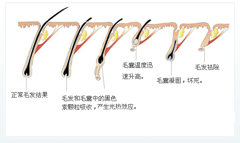 脫毛為(wèi)什麽一次性脫不幹淨？原因在這裏