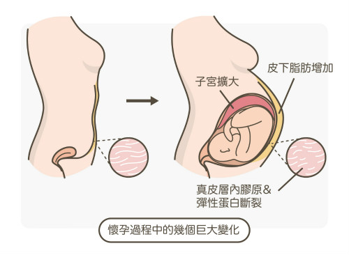 一文(wén)秒(miǎo)懂！妊娠紋肥胖紋保養、治療及預防全攻略