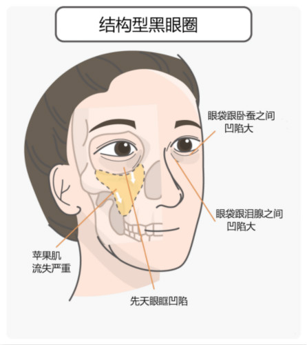 區(qū)分(fēn)黑眼圈！黑眼圈的成因、分(fēn)類、預防與治療全攻略