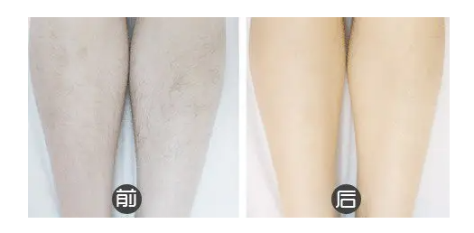 美容儀器脫毛儀在使用(yòng)中(zhōng)有(yǒu)哪些常見誤區(qū)