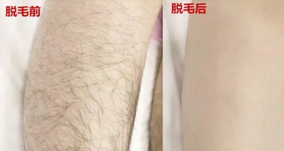 怎樣挑選高品質(zhì)美容儀器家用(yòng)脫毛儀
